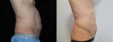 velashape before after pictures.